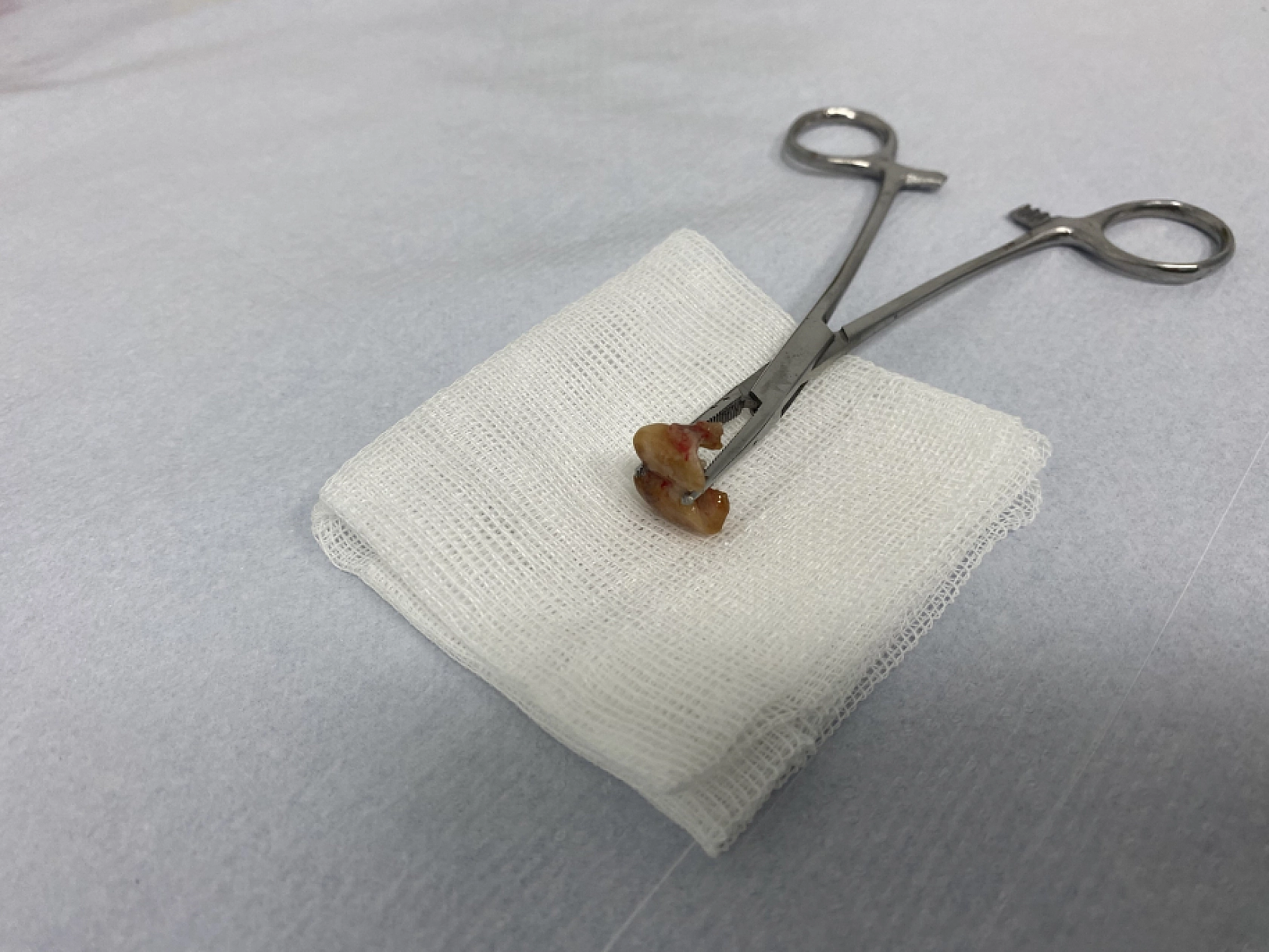 Uykusunda yuttuğu dişler bronşundan çıkarıldı