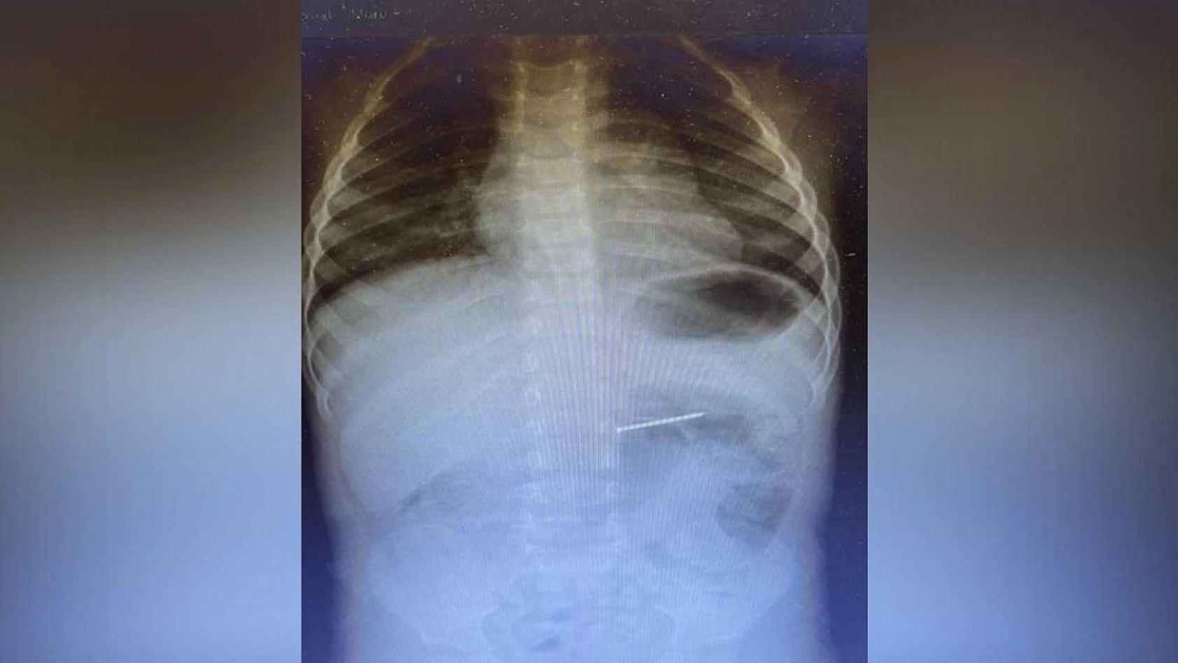 2 yaşındaki çocuğun midesinden 4 santimetrelik çivi çıktı