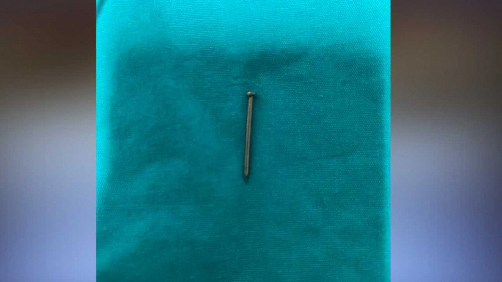 2 yaşındaki çocuğun midesinden 4 santimetrelik çivi çıktı