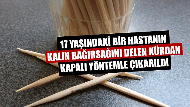 17 yaşındaki bir hastanın kalın bağırsağını delen kürdan kapalı yöntemle çıkarıldı