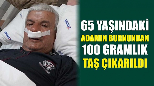 65 yaşındaki adamın burnundan 100 gramlık taş çıkarıldı