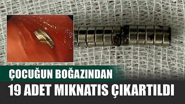 Çocuğun boğazından 19 adet mıknatıs çıkartıldı