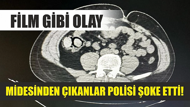 Film gibi olay: Midesinden çıkanlar polisi şoke etti!