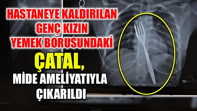 Hastaneye kaldırılan genç kızın yemek borusundaki çatal, mide ameliyatıyla çıkarıldı