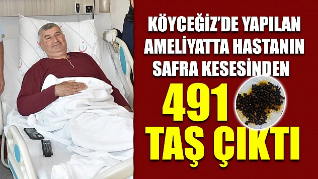Köyceğiz'de yapılan ameliyatta hastanın safra kesesinden 491 taş çıktı