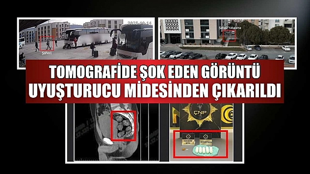 Tomografide şok eden görüntü...Uyuşturucu midesinden çıkarıldı