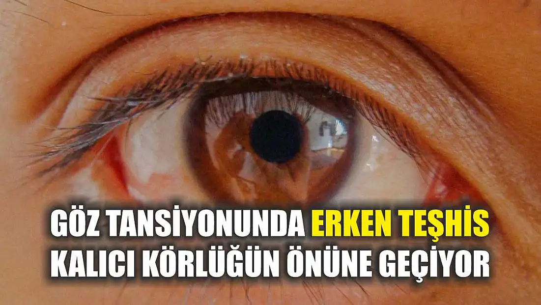 Göz tansiyonunda erken teşhis kalıcı körlüğün önüne geçiyor