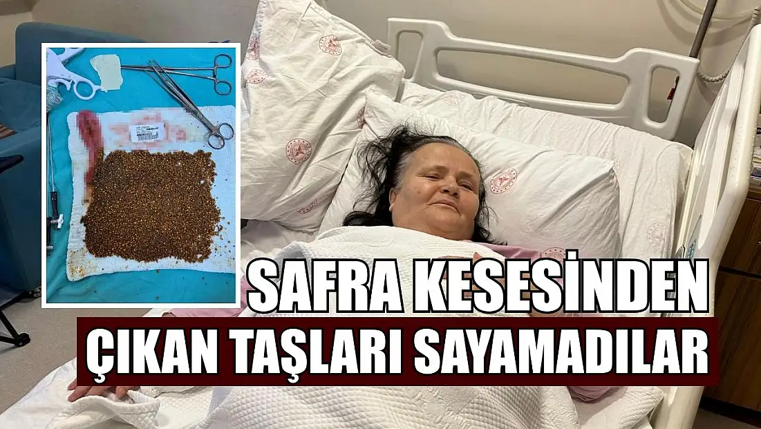 Safra kesesinden çıkan taşları sayamadılar