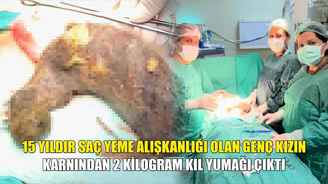 15 yıldır saç yeme alışkanlığı olan genç kızın karnından 2 kilogram kıl yumağı çıktı