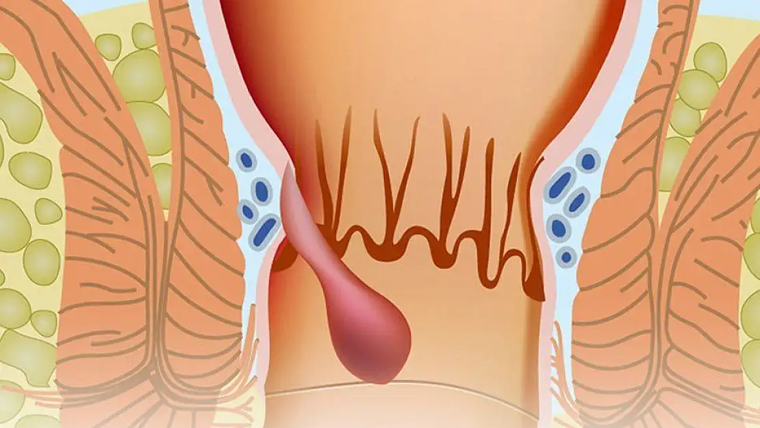 Ameliyatsız Hemoroid tedavisi