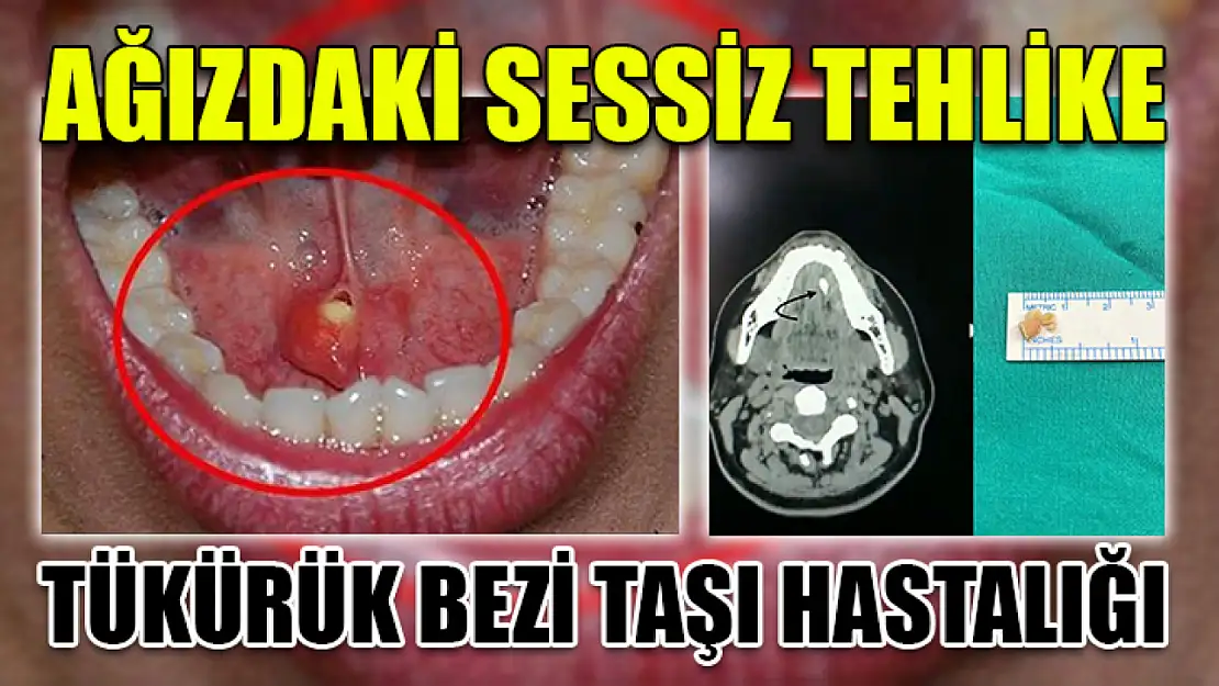 Ağızdaki sessiz tehlike: Tükürük bezi taşı hastalığı