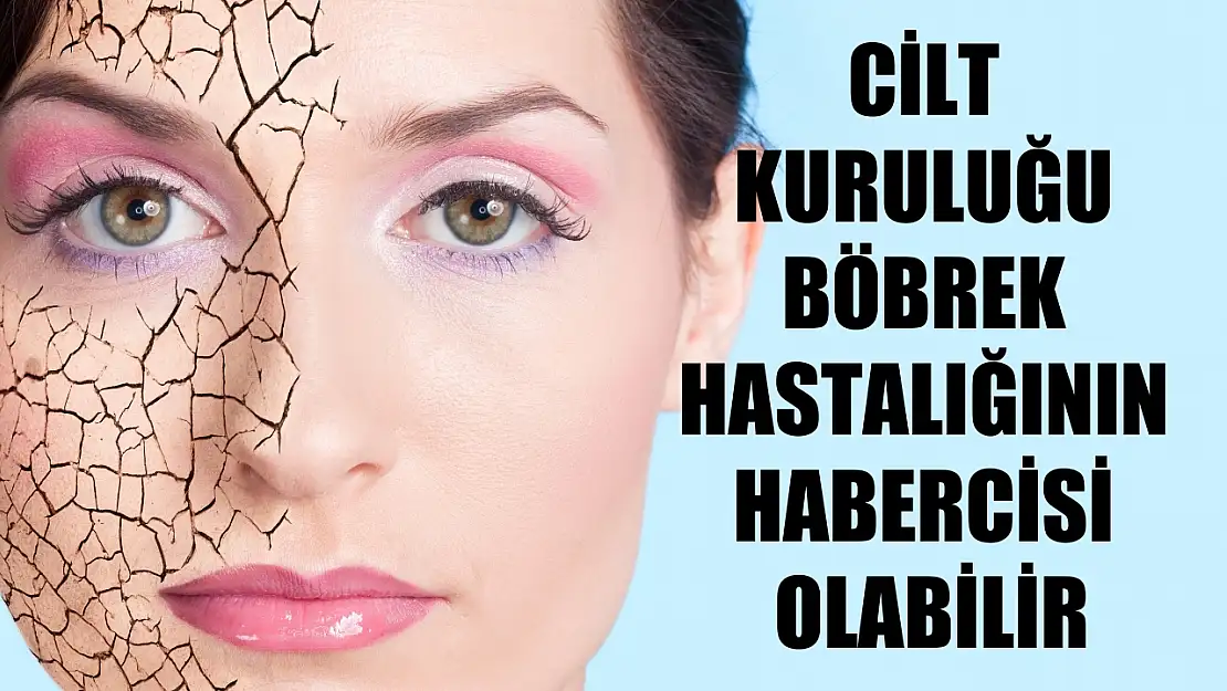 Cilt kuruluğu böbrek hastalığının habercisi olabilir