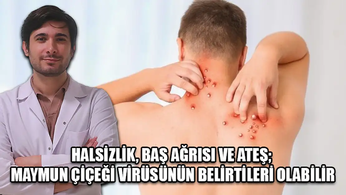 Halsizlik, Baş Ağrısı Ve Ateş Maymun Çiçeği Virüsünün Belirtileri Olabilir