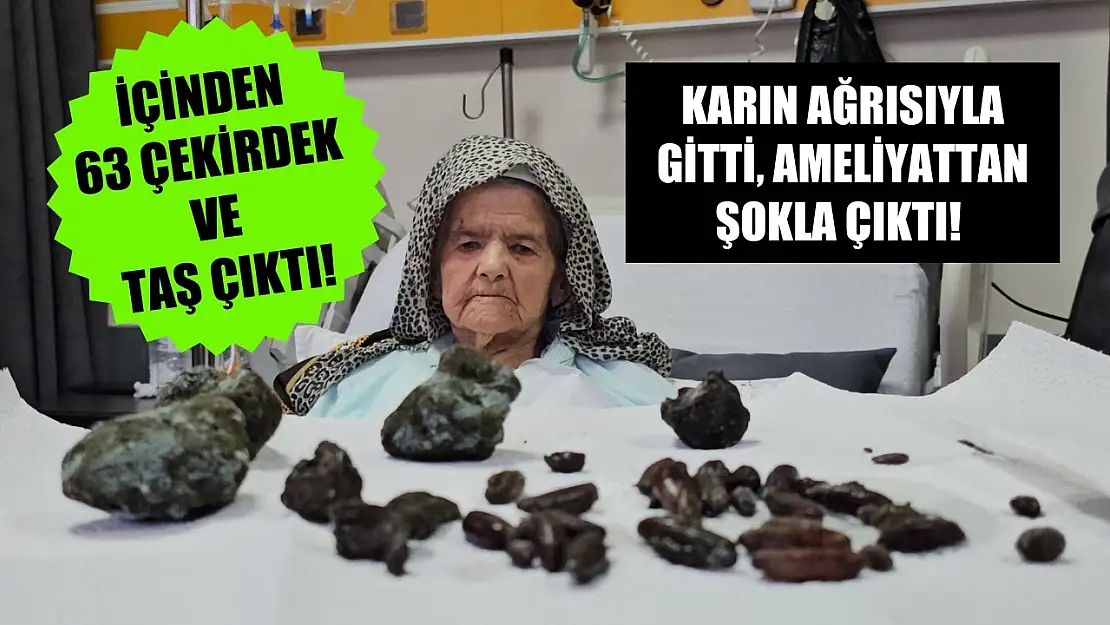 Karın Ağrısıyla Gitti, Ameliyattan Şokla Çıktı! İçinden 63 Çekirdek ve Taş Çıktı!