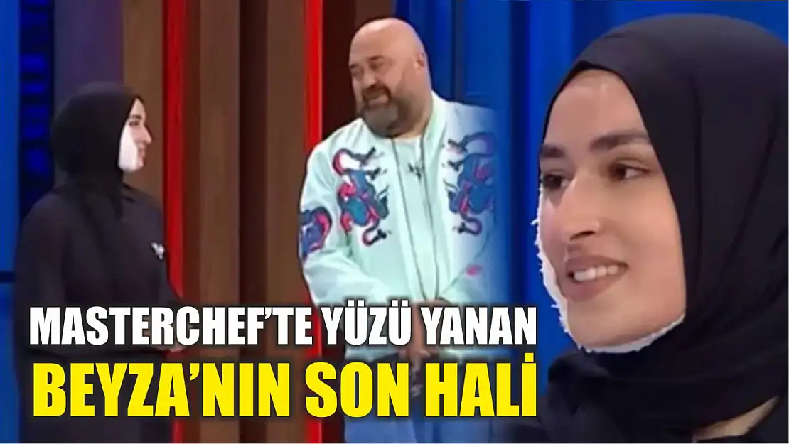 Masterchef'te yüzü yanan Beyza'nın son hali