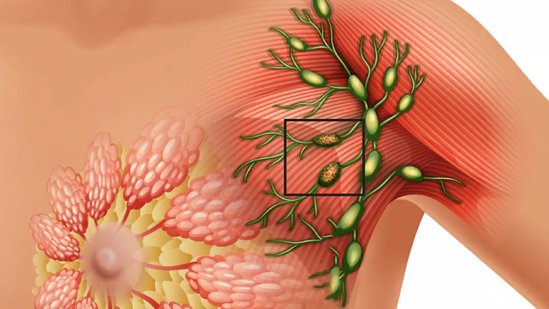 Meme Kanserini Yenen Hastalar Bu Kanser Türü İle Karşı Karşıya