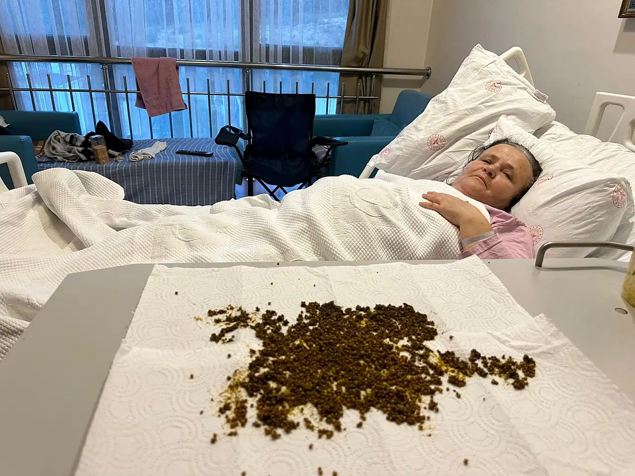 Safra kesesinden çıkan taşları sayamadılar