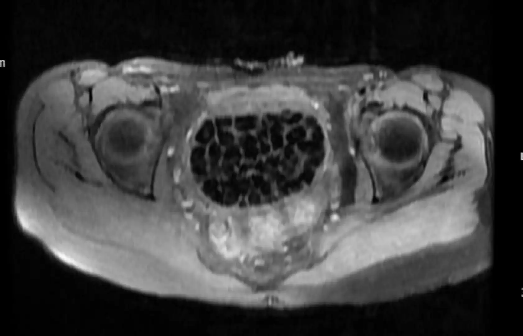 Vücudundan 287 tane taş çıkarıldı, doktorlar bile şok oldu: 'Literatürde çok nadir görülen bir olay'