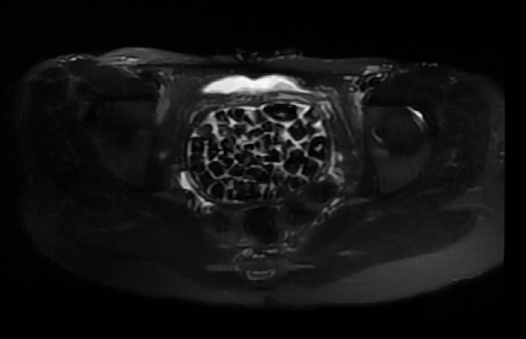 Vücudundan 287 tane taş çıkarıldı, doktorlar bile şok oldu: 'Literatürde çok nadir görülen bir olay'