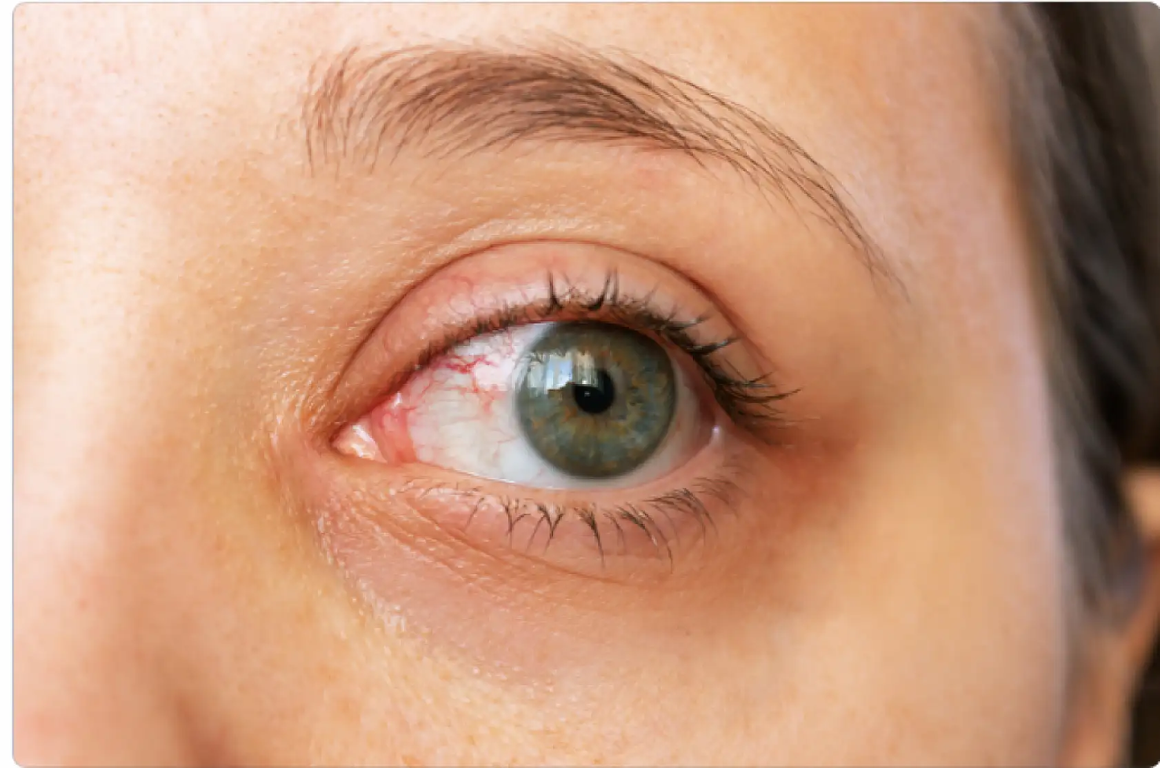 İnanılmaz gerçek: Göz kuruluğu beyin tümörünün ilk ipucu olabilir