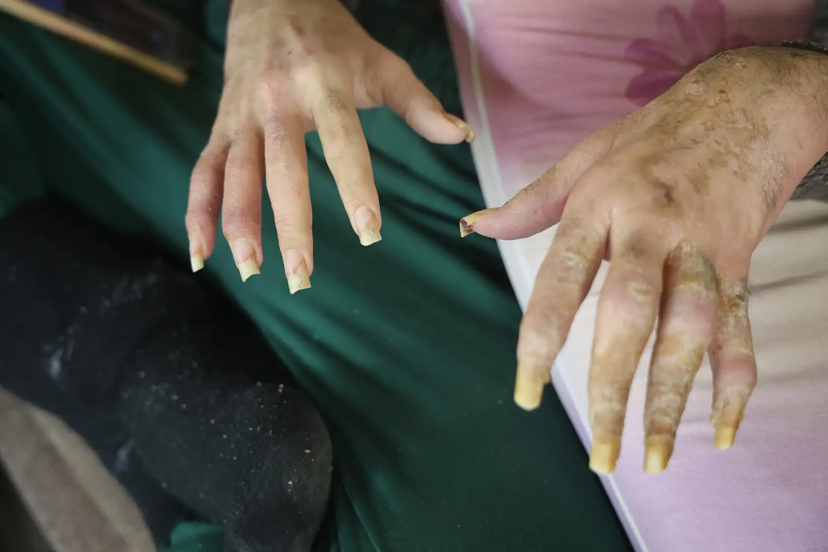 Telefon bağımlısı genç: 3 yıldır evden dışarı ne tek bir adım attı ne de beslenmek dışında bir şey yaptı