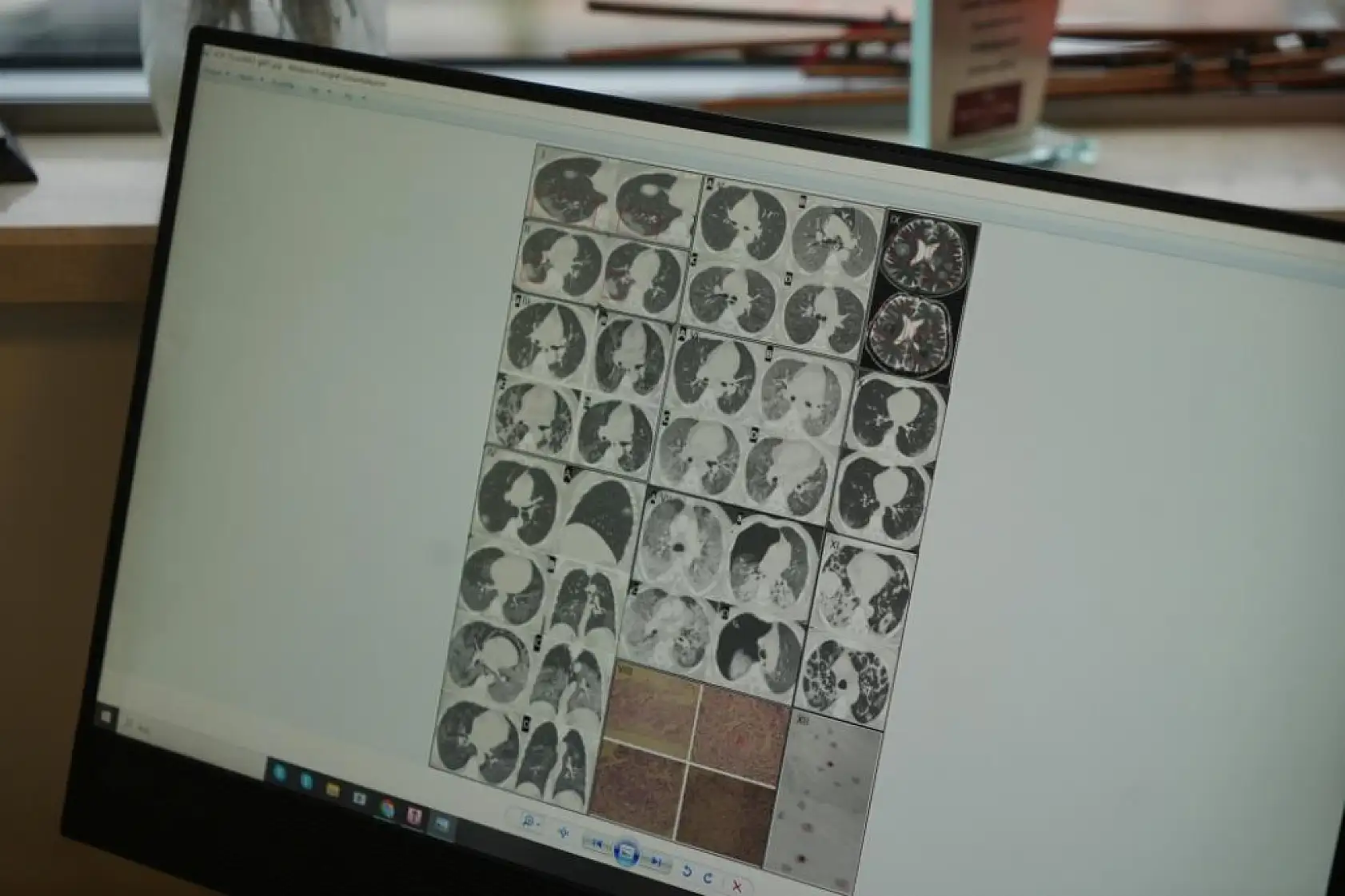 Gençlerde ani ölümler artıyor: 'Nedeni ise virüsün damarlarda bıraktığı hasar'