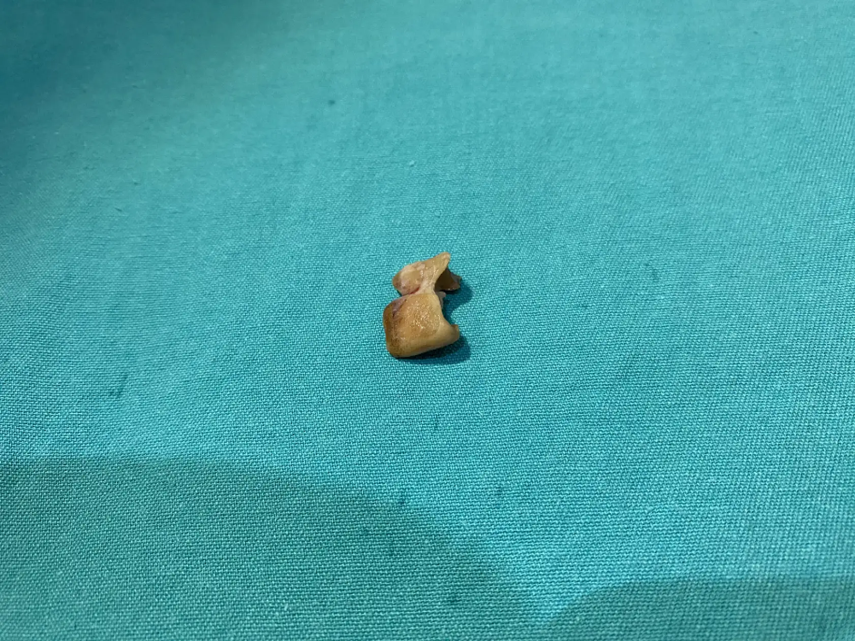 Uykusunda yuttuğu dişler bronşundan çıkarıldı