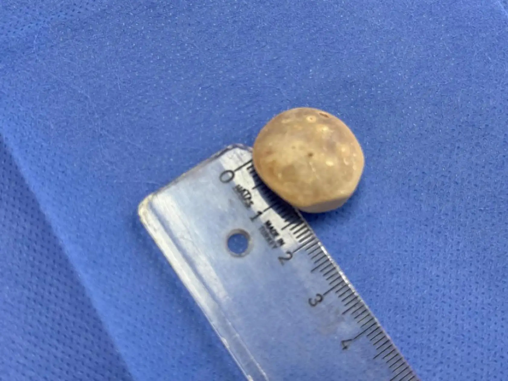 Vücudundan 287 tane taş çıkarıldı, doktorlar bile şok oldu: 'Literatürde çok nadir görülen bir olay'