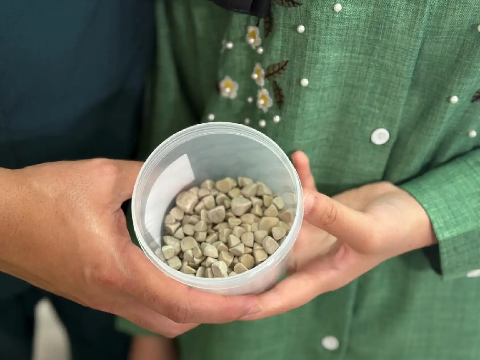 Vücudundan 287 tane taş çıkarıldı, doktorlar bile şok oldu: 'Literatürde çok nadir görülen bir olay'