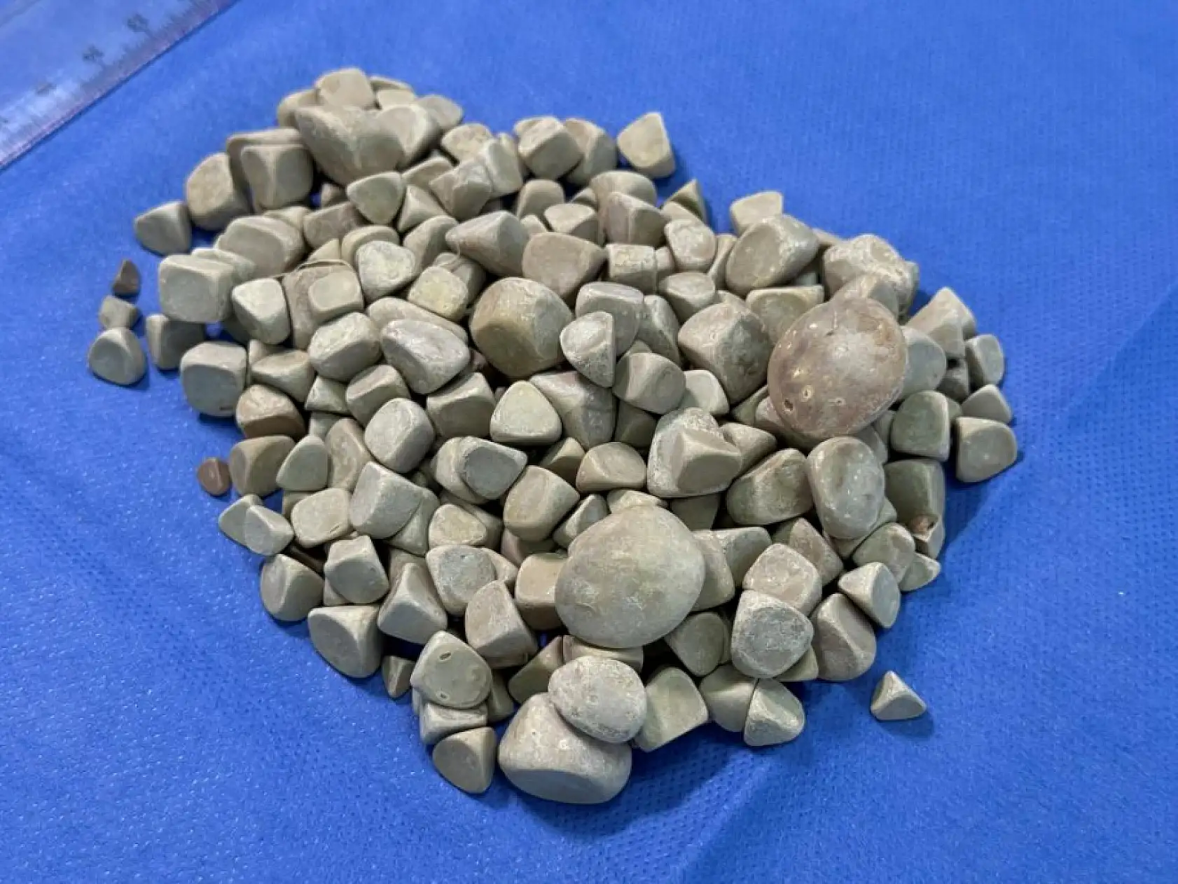 Vücudundan 287 tane taş çıkarıldı, doktorlar bile şok oldu: 'Literatürde çok nadir görülen bir olay'