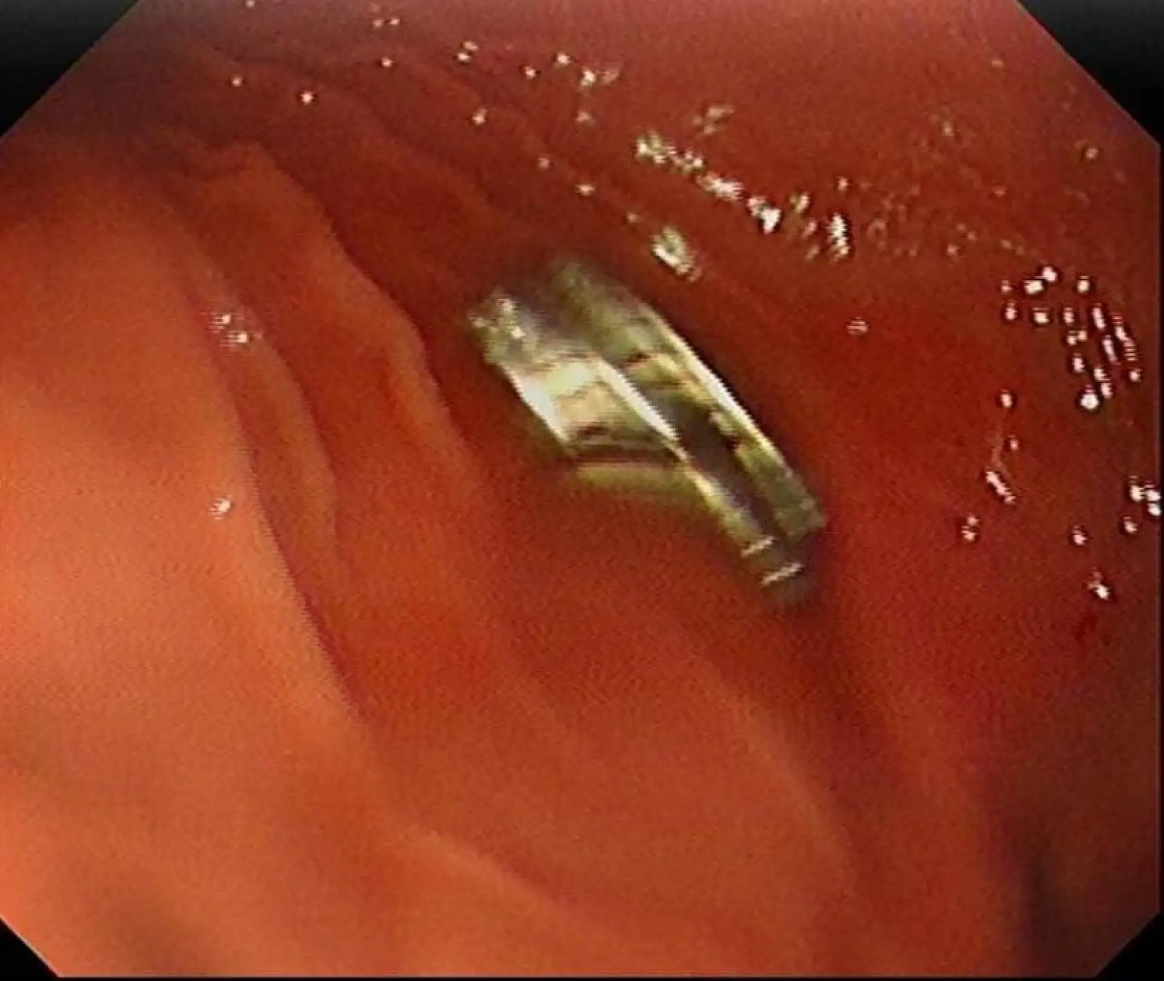 Çocuğun boğazından 19 adet mıknatıs çıkartıldı