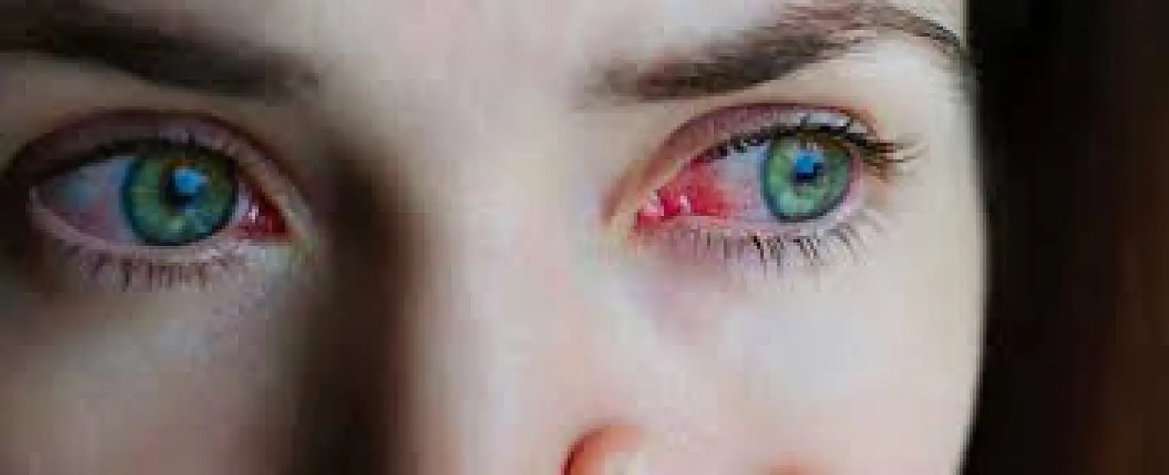 Kışla birlikte gelen göz enfeksiyonlarına dikkat!