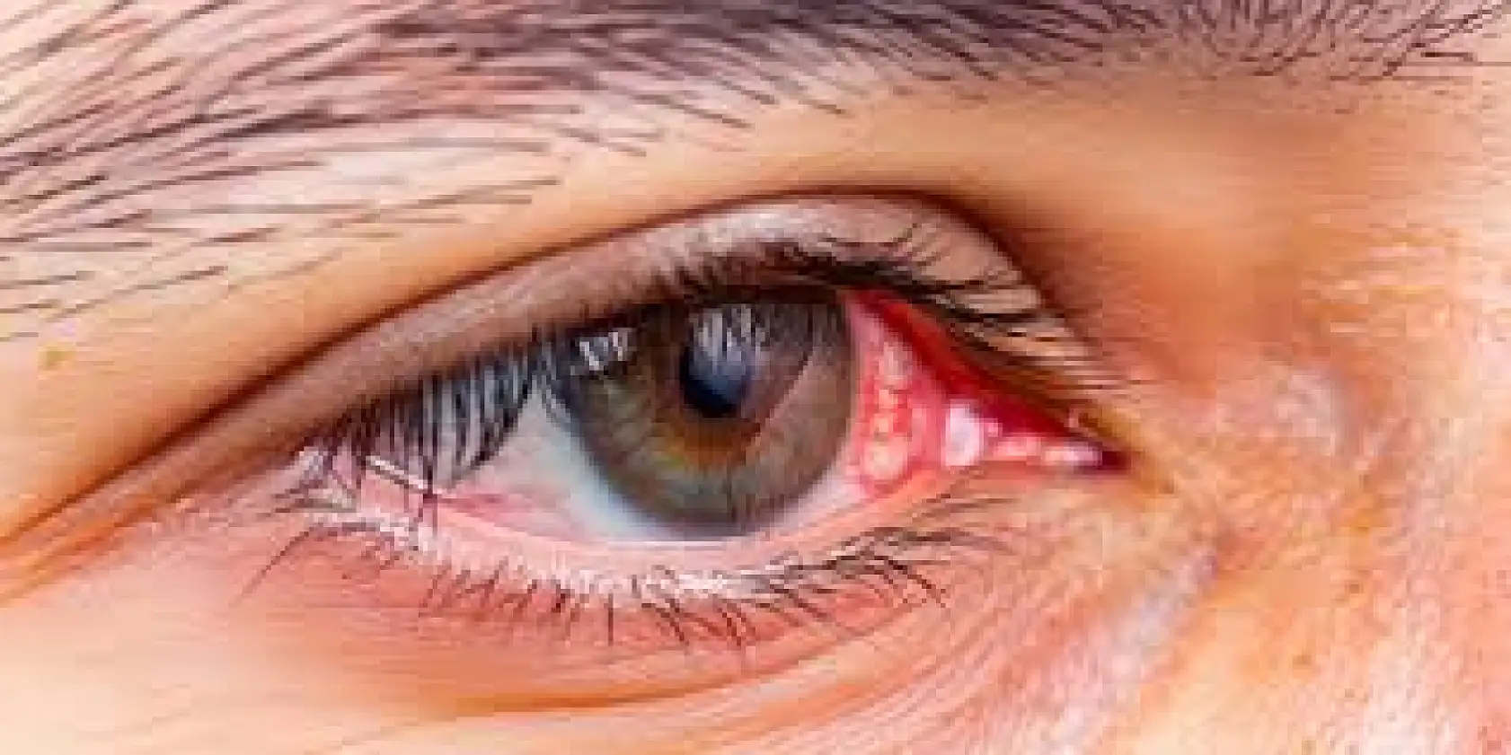 Kışla birlikte gelen göz enfeksiyonlarına dikkat!