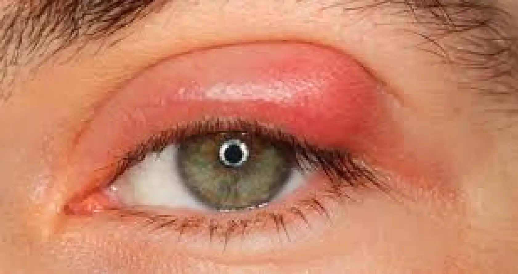 Kışla birlikte gelen göz enfeksiyonlarına dikkat!