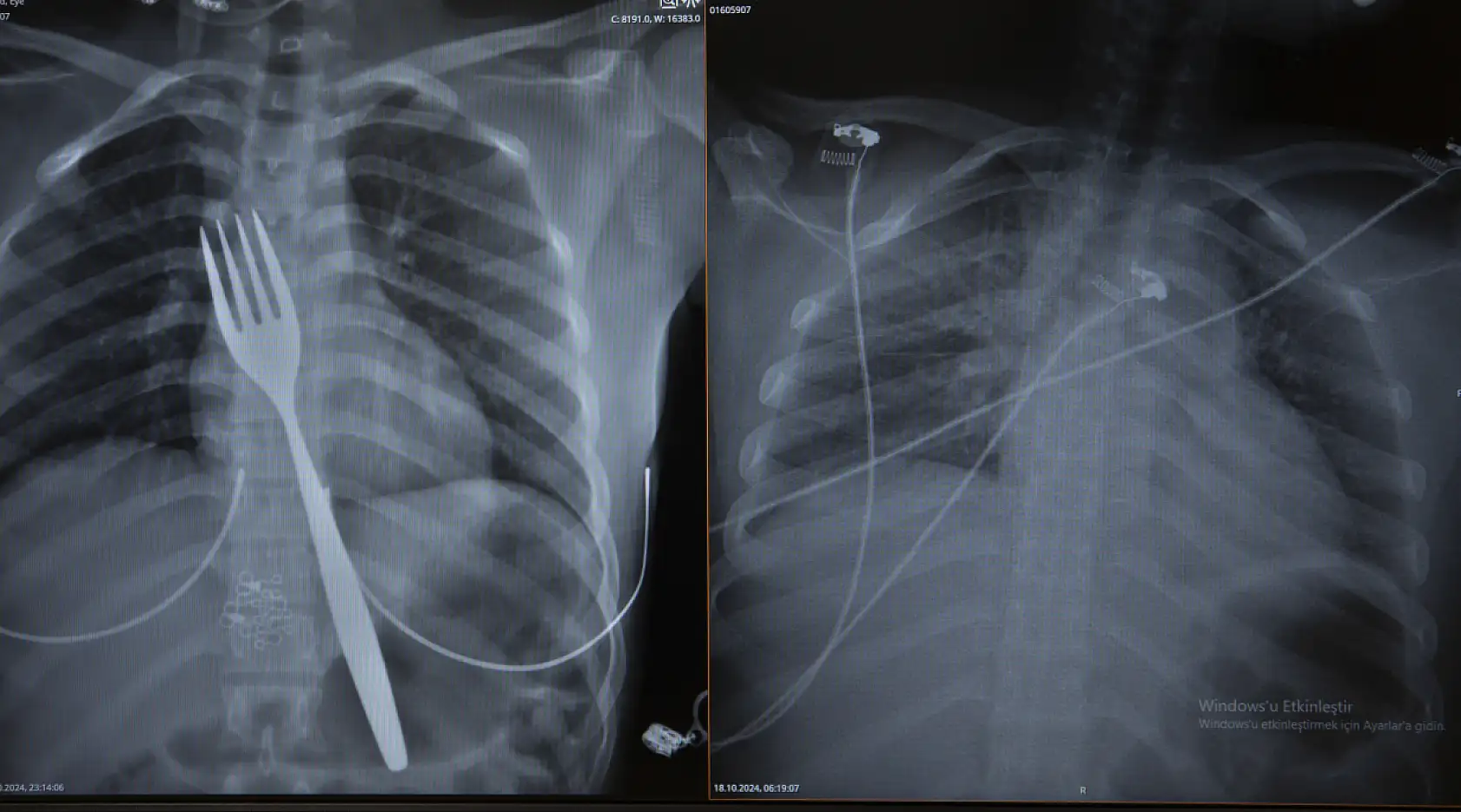 Hastaneye kaldırılan genç kızın yemek borusundaki çatal, mide ameliyatıyla çıkarıldı