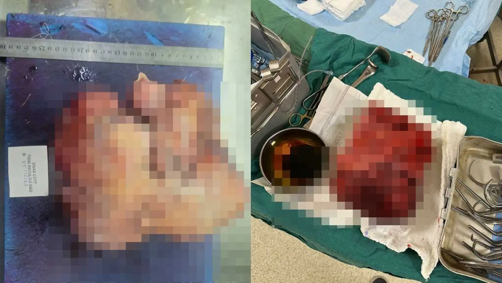 Nefes darlığı şikayeti ile hastaneye gitti, göğsünden 3 kilogramlık tümör çıktı