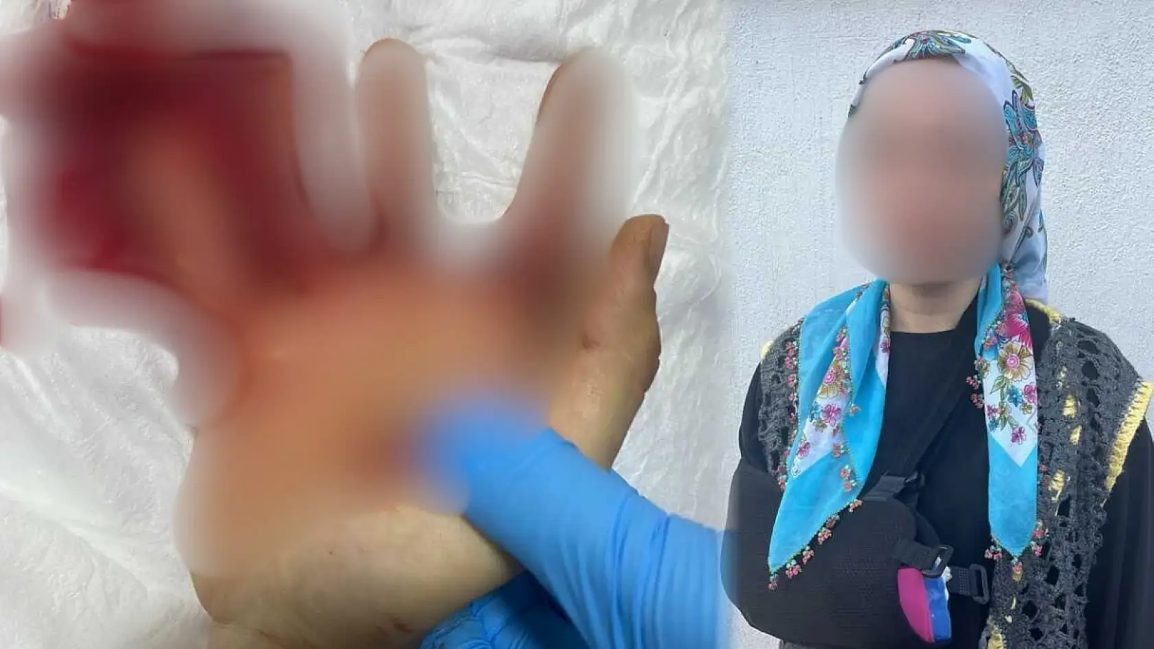 Fethiye'de Pazardaki Bıçaklı Kavgada Genç Kadın Elini Kaybetme Riskiyle Karşı Karşıya