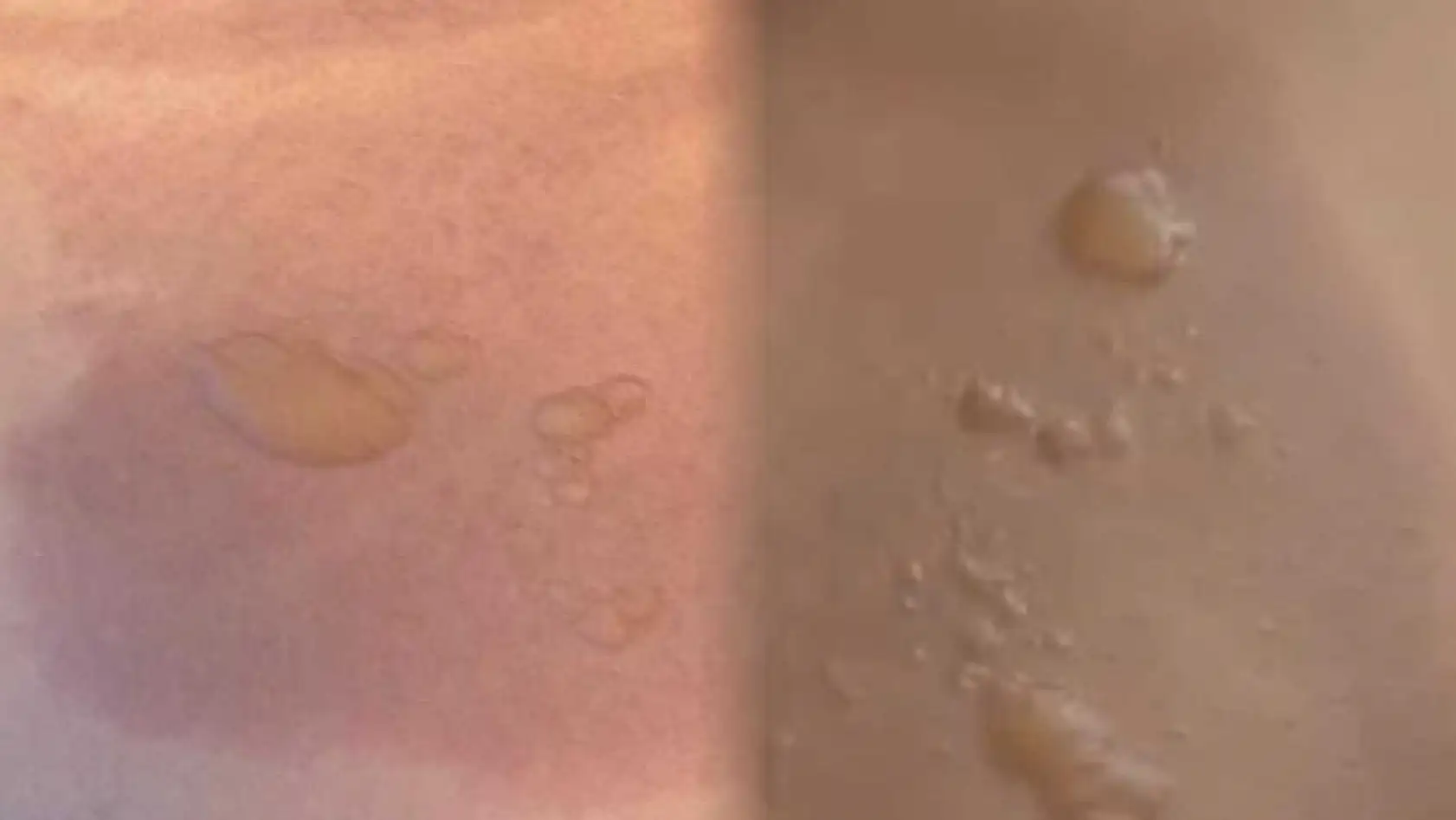 Yine sıcak su torbası yine facia: 'Koyduktan 3 dakika sonra patladı'