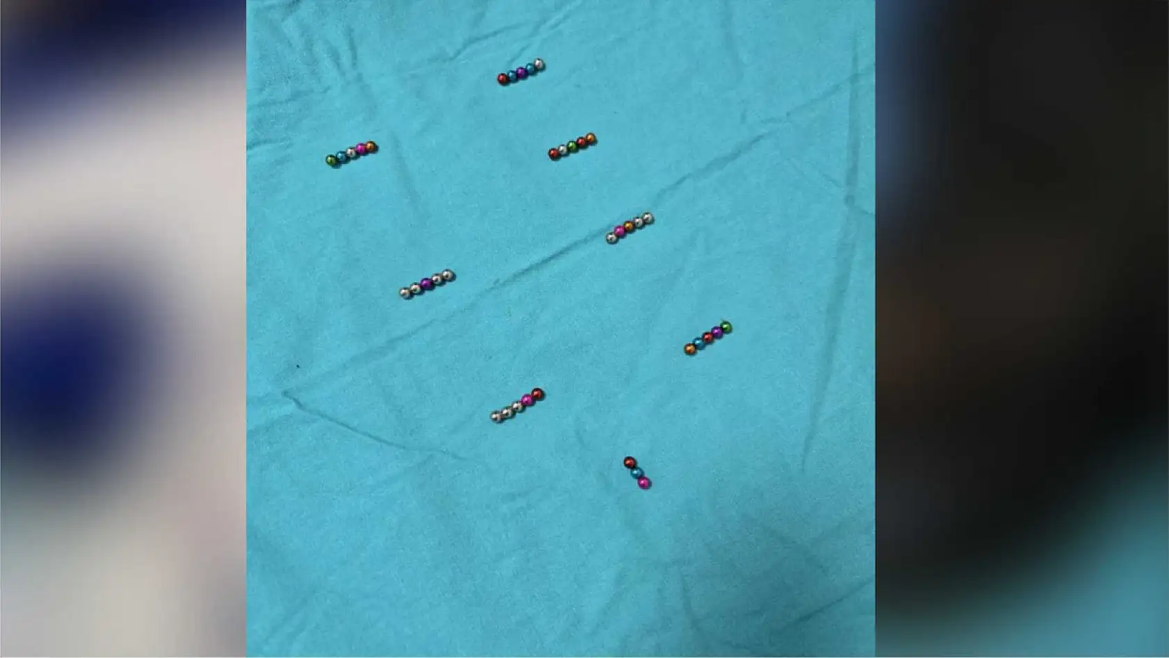 5 yaşındaki çocuğun bağırsağından 38 adet mıknatıs çıkarıldı