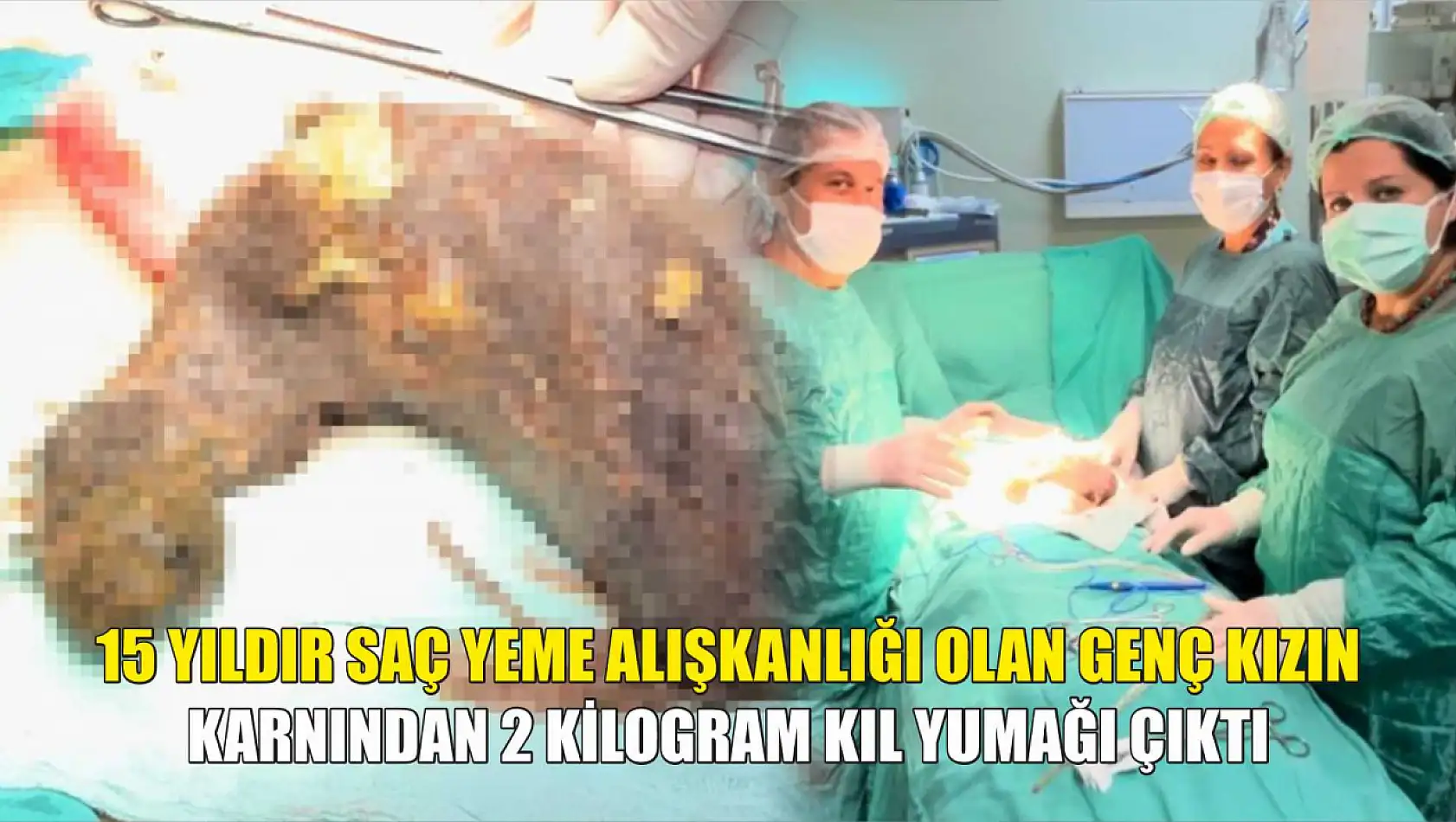 15 yıldır saç yeme alışkanlığı olan genç kızın karnından 2 kilogram kıl yumağı çıktı