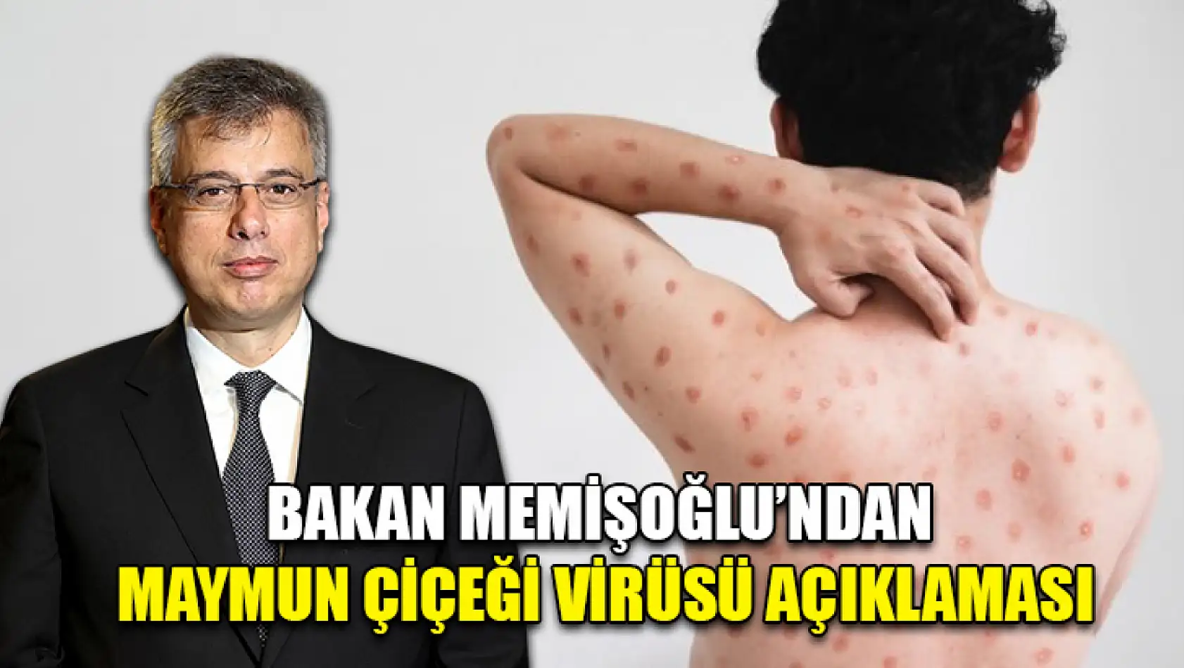 Bakan Memişoğlu'ndan Maymun Çiçeği Virüsü Açıklaması