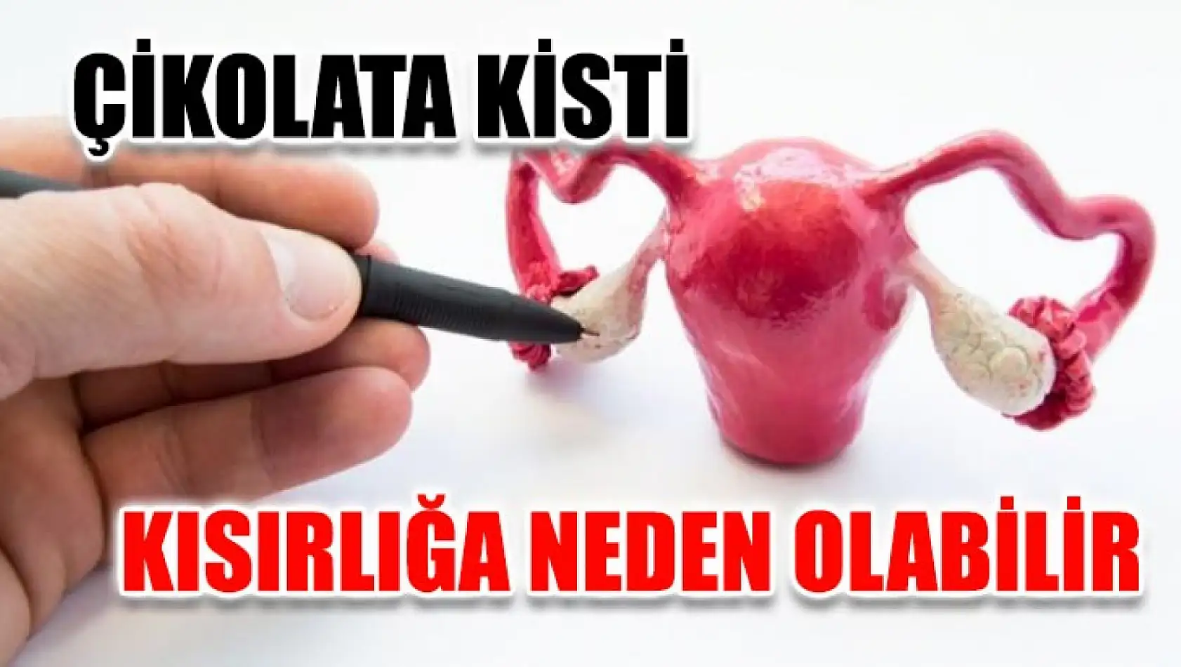 Çikolata Kisti Kısırlığa Neden Olabilir