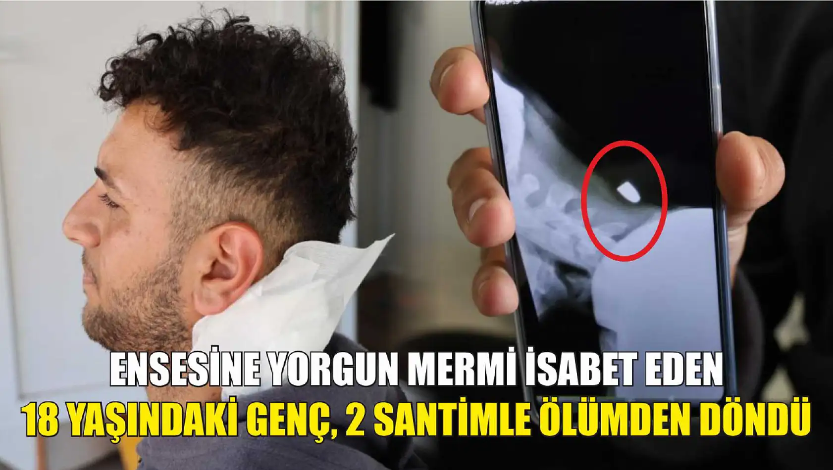 Ensesine yorgun mermi isabet eden 18 yaşındaki genç, 2 santimle ölümden döndü