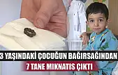 3 yaşındaki çocuğun bağırsağından 7 tane mıknatıs çıktı