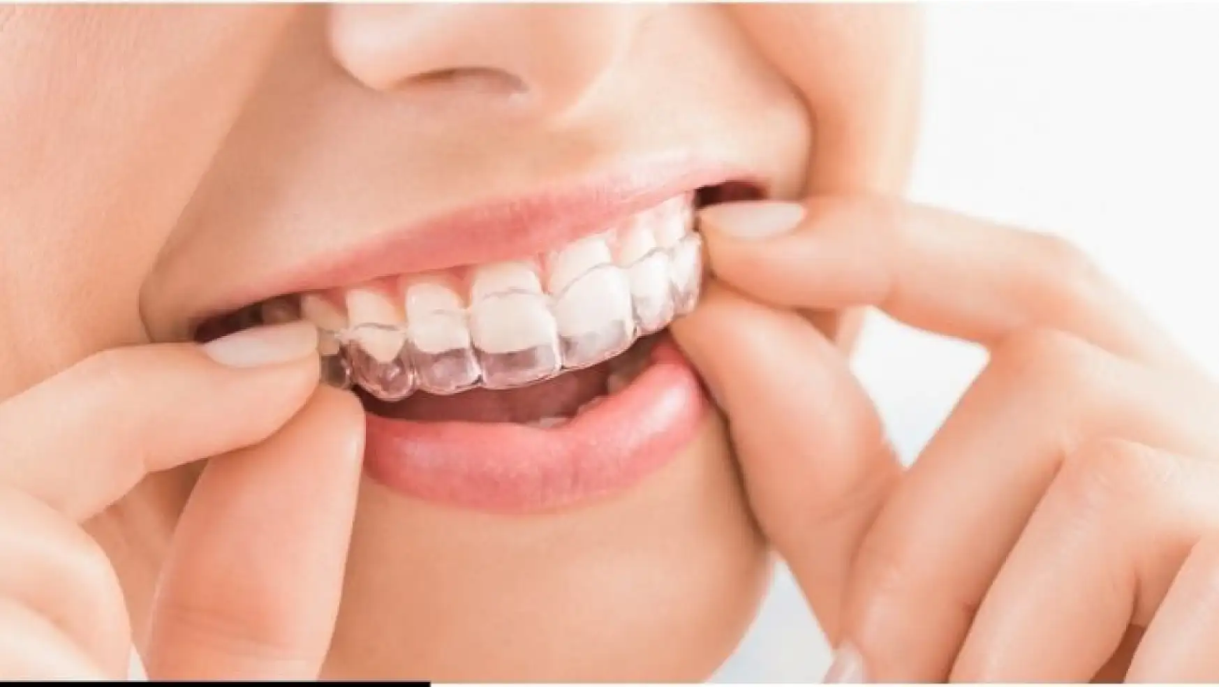 Diş Teline Avantajlı Alternatif: Şeffaf Plaklar