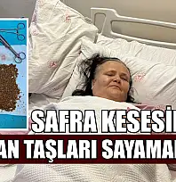 Safra kesesinden çıkan taşları sayamadılar