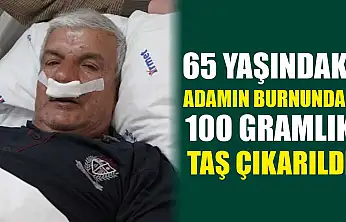 65 yaşındaki adamın burnundan 100 gramlık taş çıkarıldı