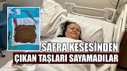 Safra kesesinden çıkan taşları sayamadılar