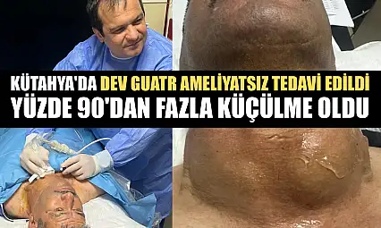 Kütahya'da dev guatr ameliyatsız tedavi edildi: Yüzde 90'dan fazla küçülme oldu