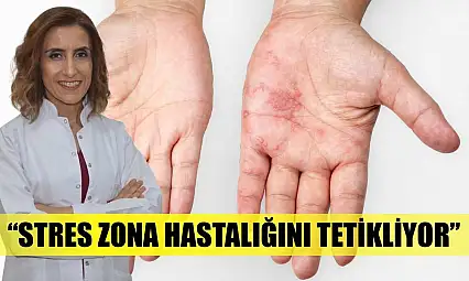 'Stres zona hastalığını tetikliyor'